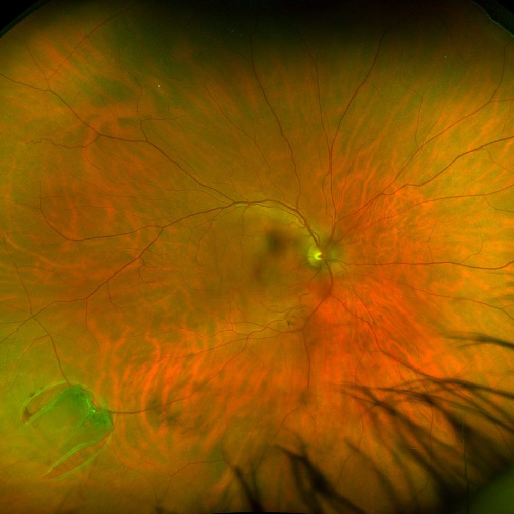 Retinal image showing optical coherence tomography at D.A. Seaman Optometrists